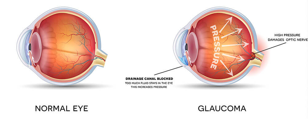 Chart Illustrating a Normal Eye Compared to One With Glaucoma